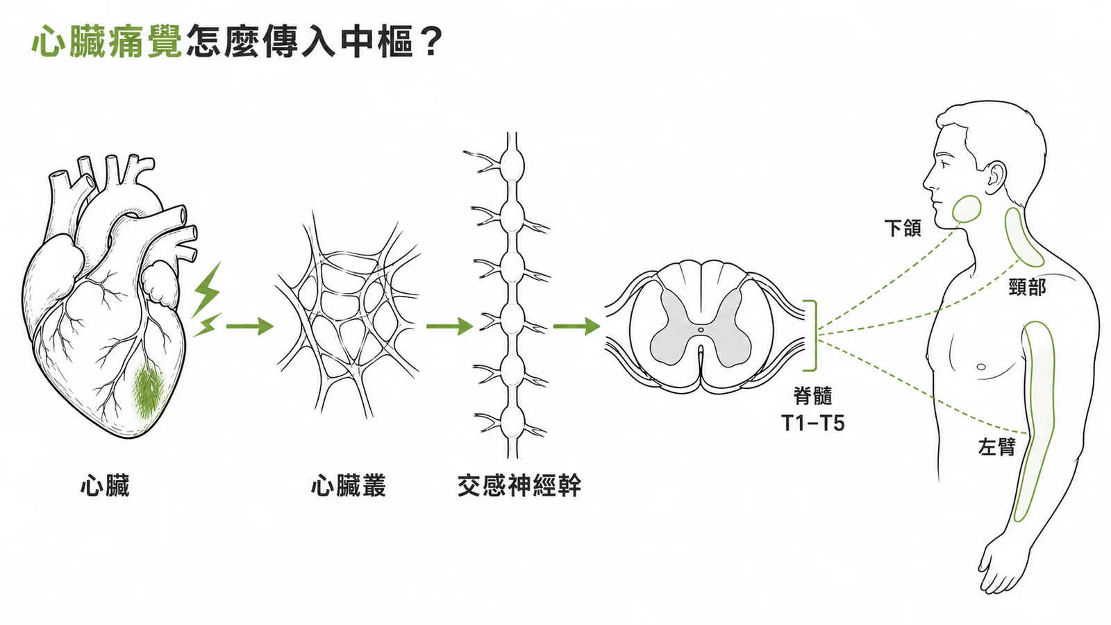 心臟缺血痛覺傳遞路徑:心臟→心臟叢→交感神經幹→脊髓 T1-T5,並產生左臂、頸部轉移痛