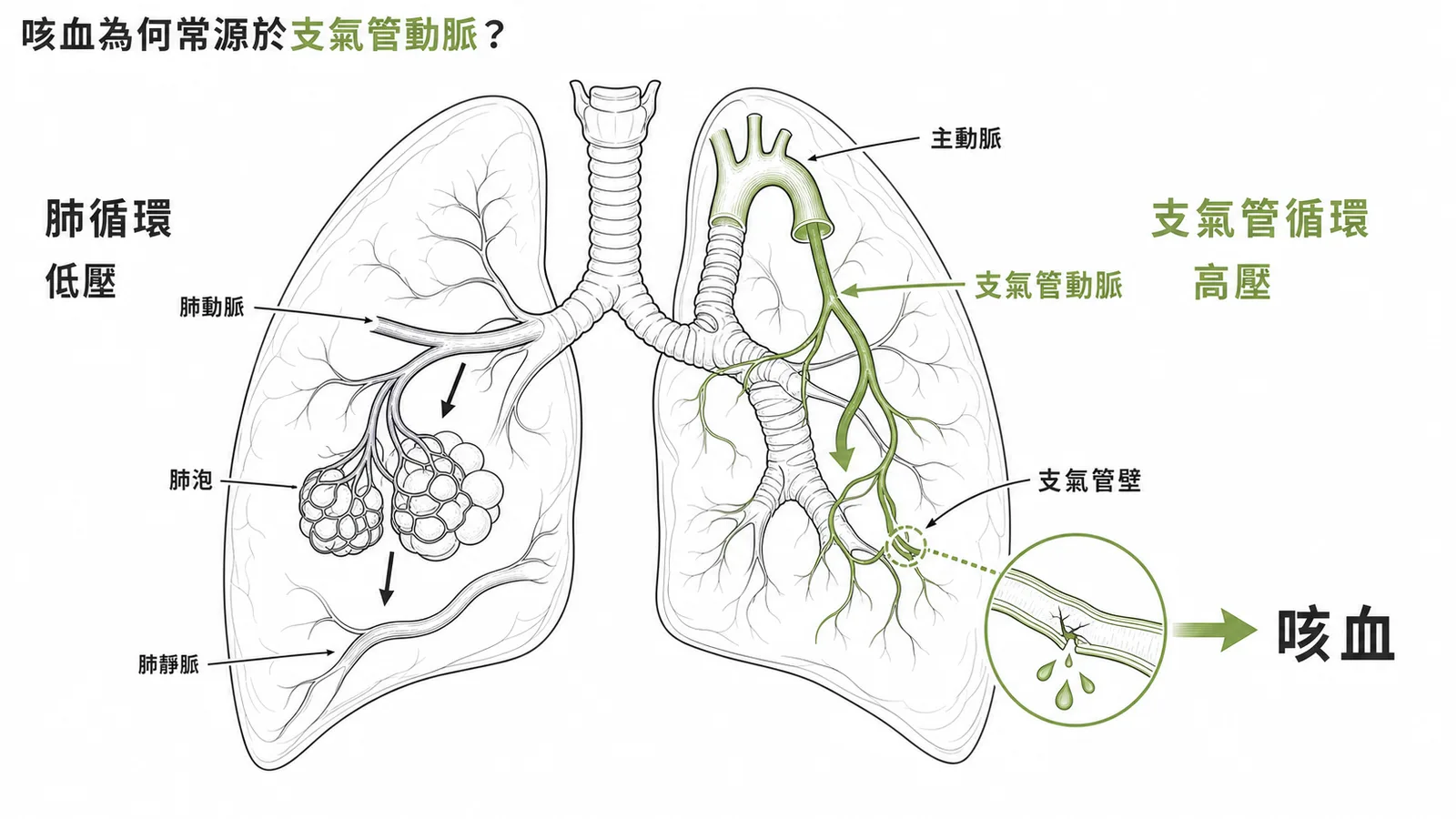 肺部兩套供血對比:支氣管動脈屬體循環高壓,破裂時最常導致咳血