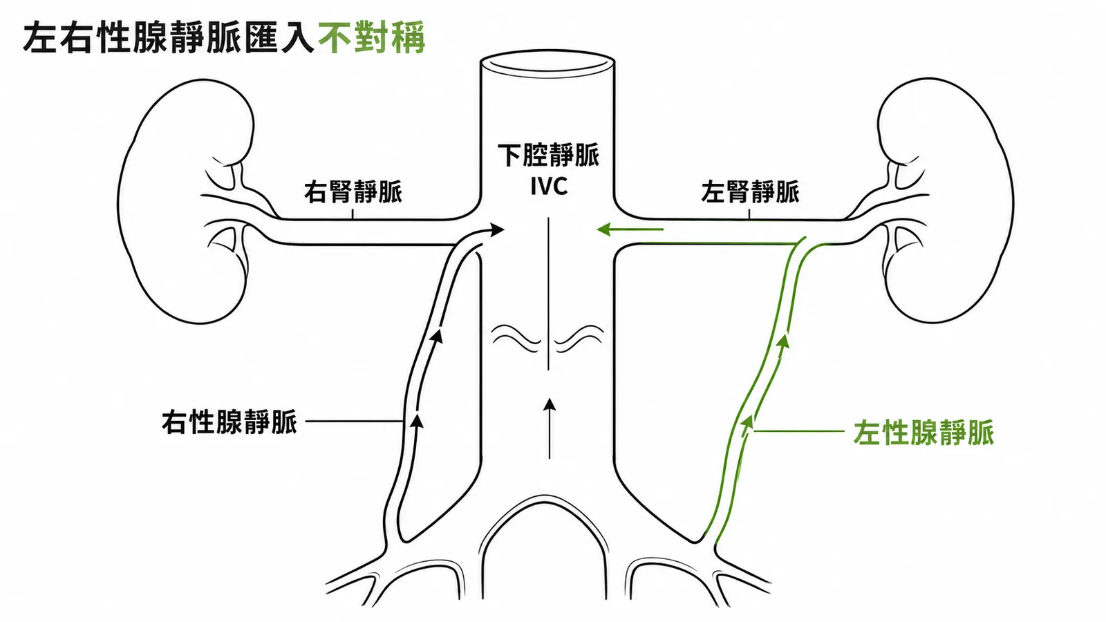 左右性腺靜脈匯入路徑不對稱：左側經左腎靜脈、右側直接入下腔靜脈