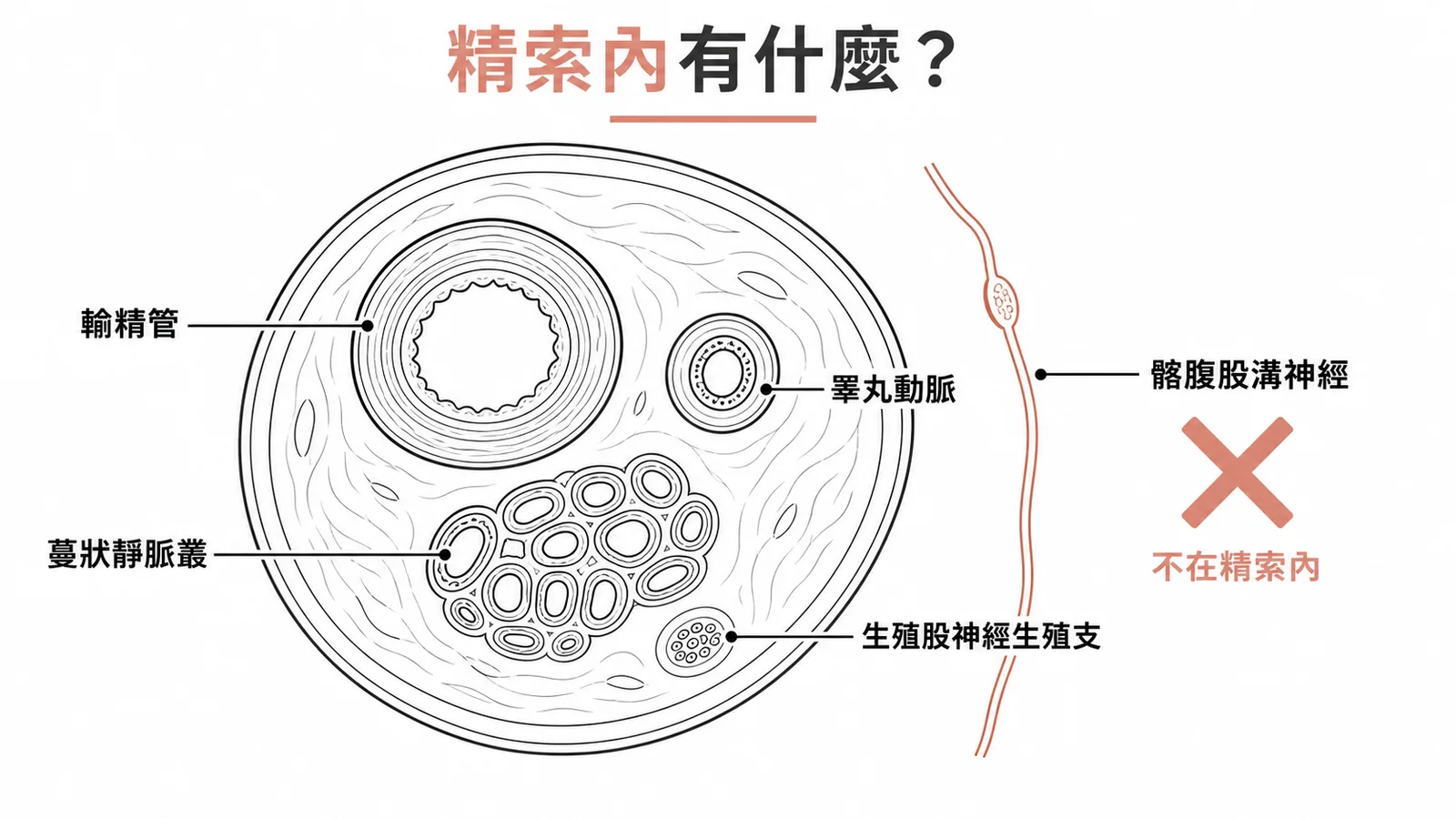 精索橫切面:內含輸精管、睪丸動脈、蔓狀靜脈叢等,髂腹股溝神經在精索外
