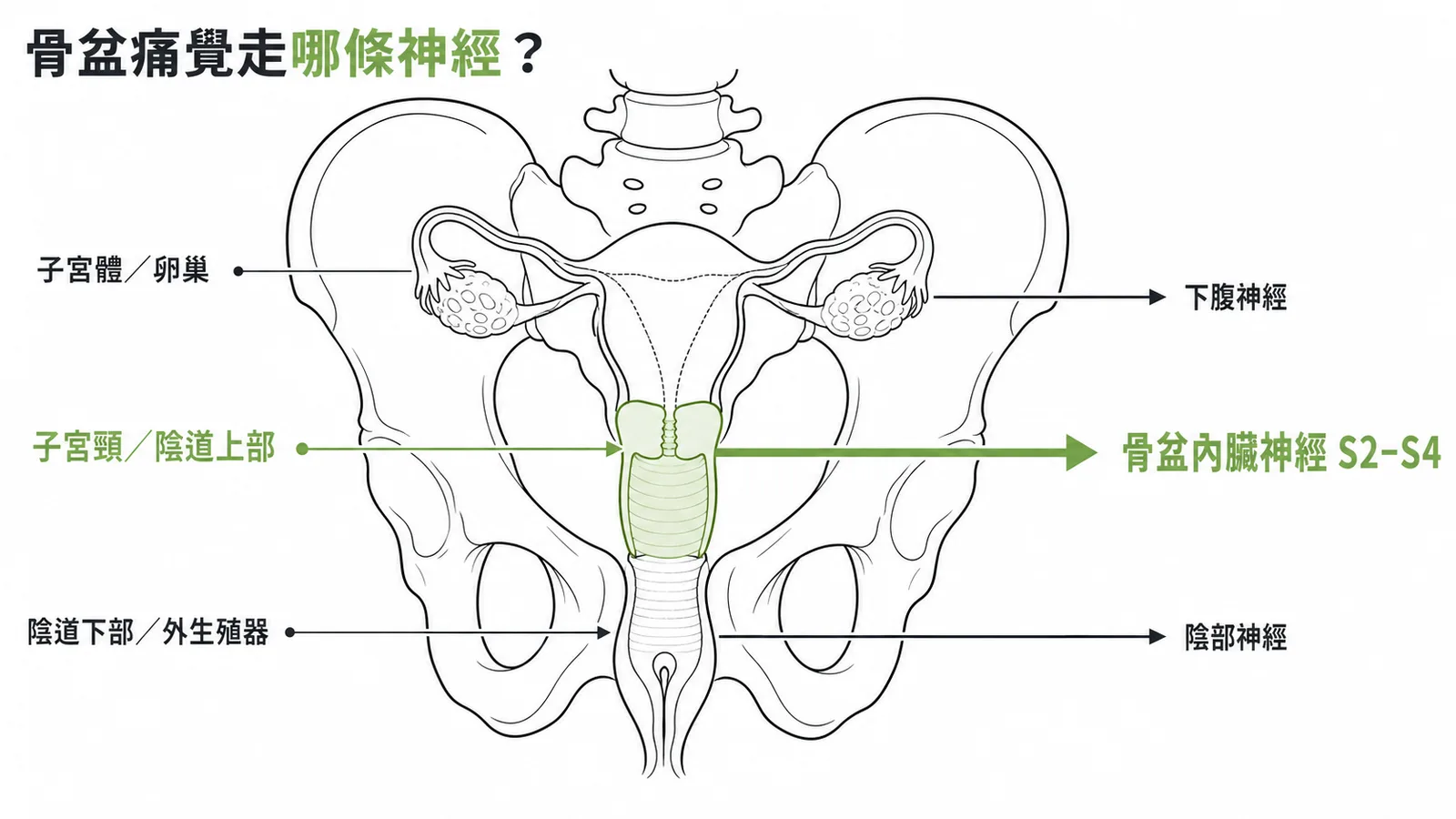骨盆痛覺傳導:子宮體走下腹神經、陰道上部子宮頸走骨盆內臟神經S2-S4、陰道下部走陰部神經