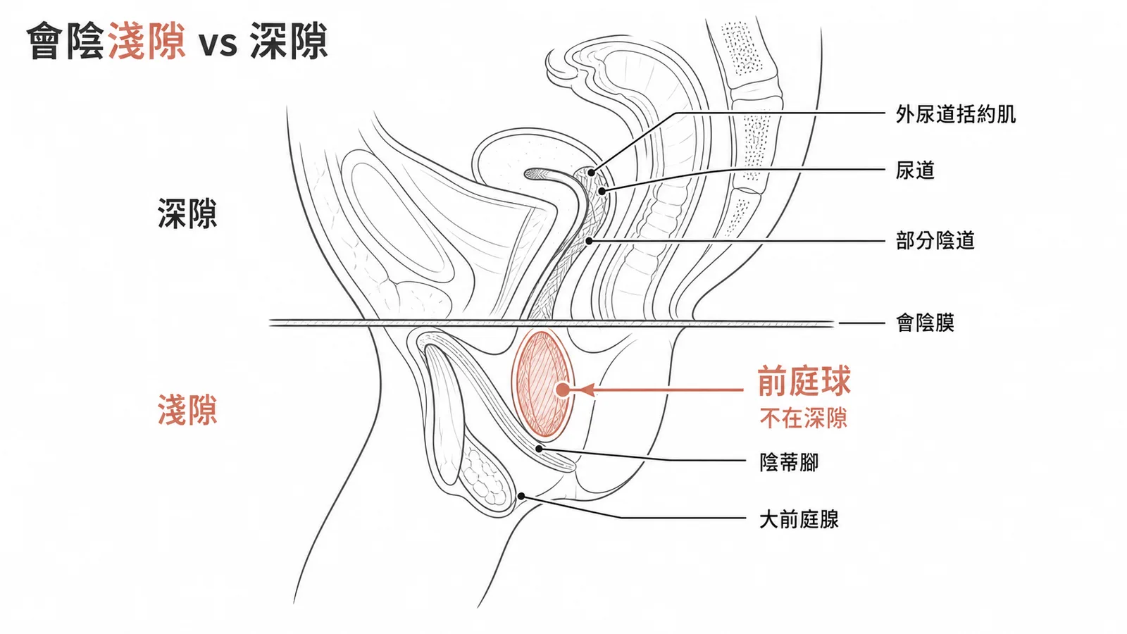女性會陰淺隙vs深隙:前庭球在淺隙、外尿道括約肌在深隙