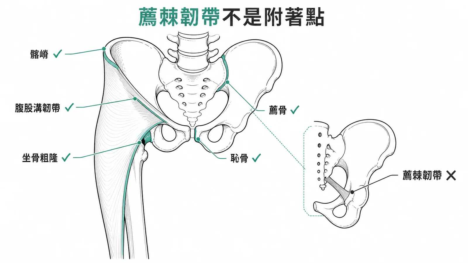 薦棘韌帶不是闊筋膜附著點——左側骨盆標示闊筋膜五大附著處,右側標示薦棘韌帶位於骨盆腔內與闊筋膜無關