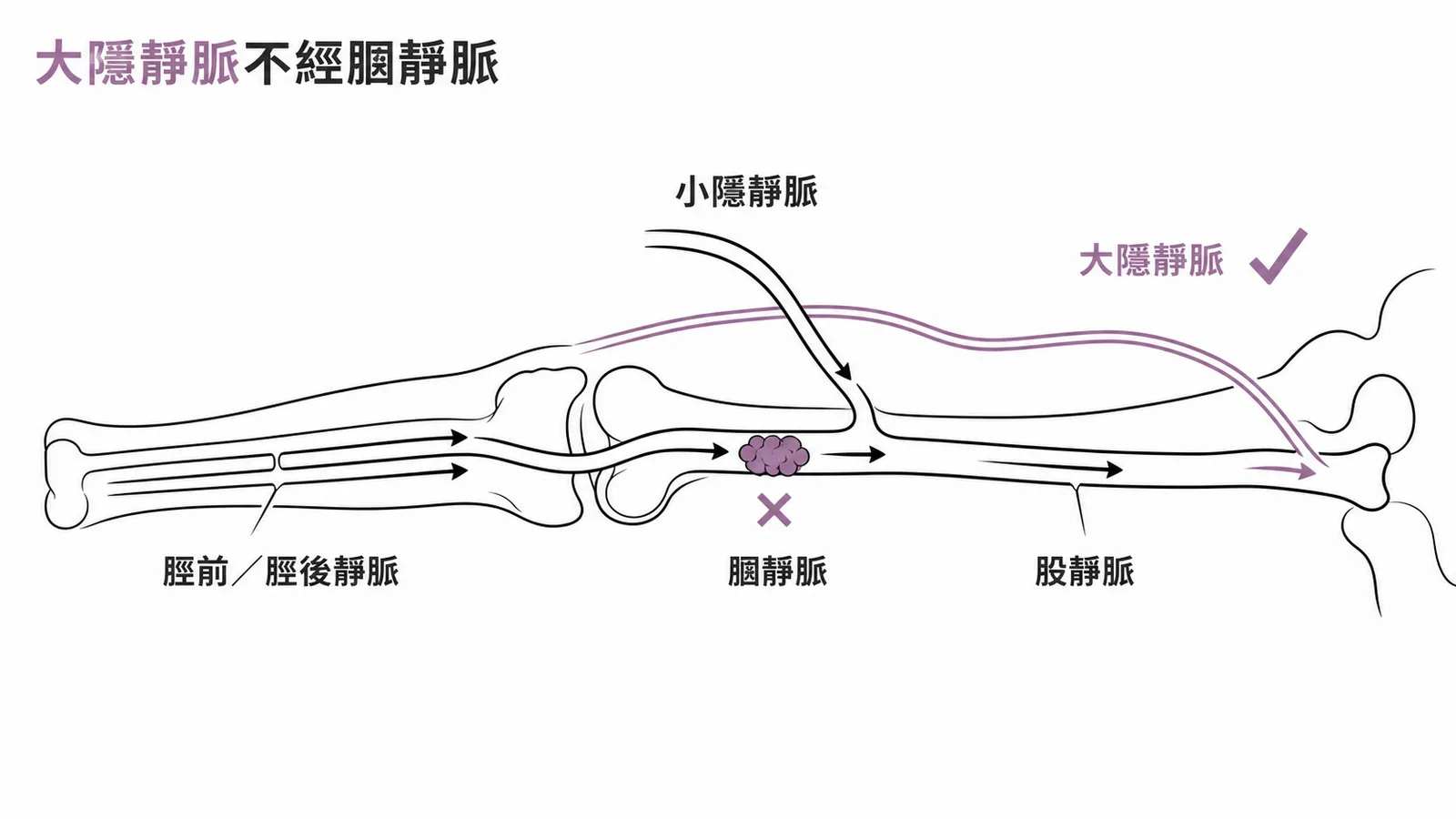 大隱靜脈不經膕靜脈——下肢靜脈匯流路徑,大隱靜脈直接匯入股靜脈,膕靜脈血栓不影響其血流