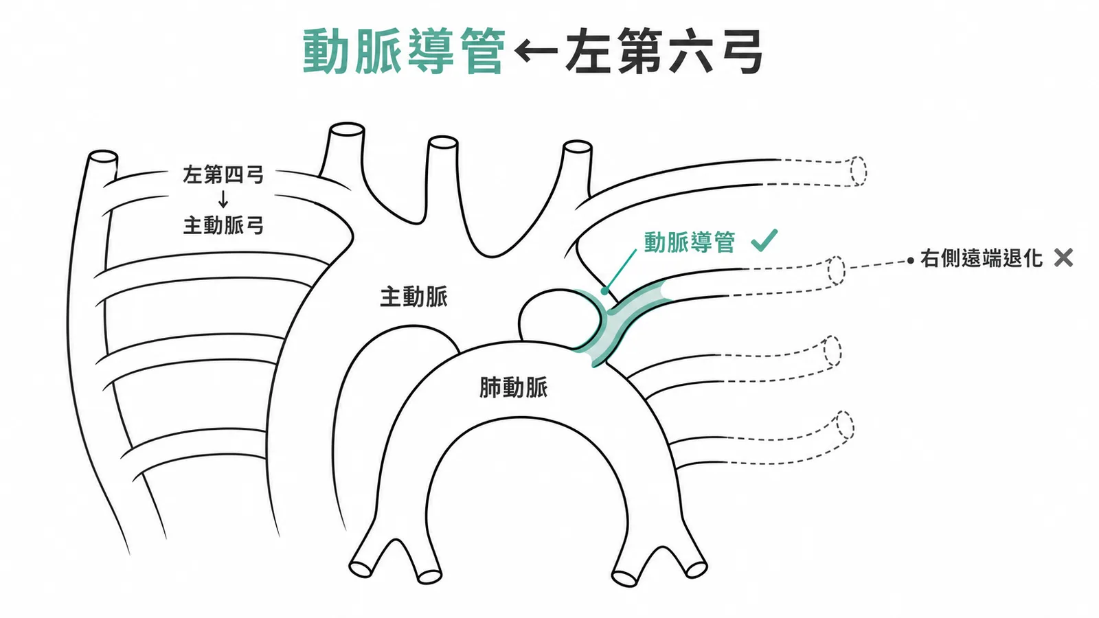 動脈導管源自左第六弓——動脈弓系統示意,左第六弓遠端形成動脈導管連接肺動脈與主動脈