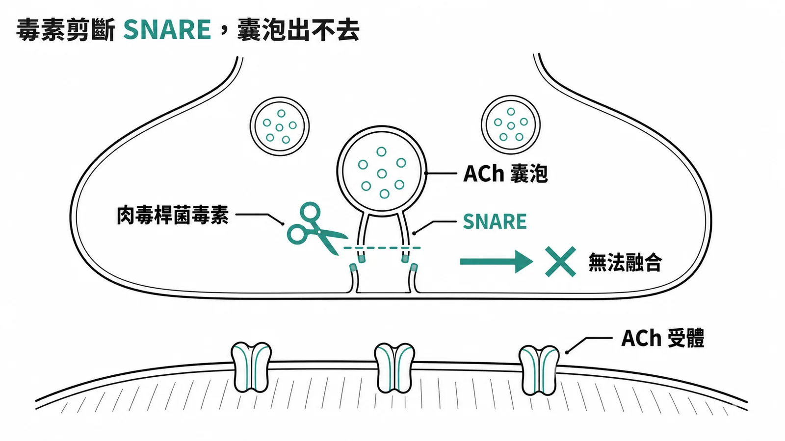 肉毒桿菌毒素剪斷 SNARE 蛋白阻斷 ACh 囊泡釋放示意圖