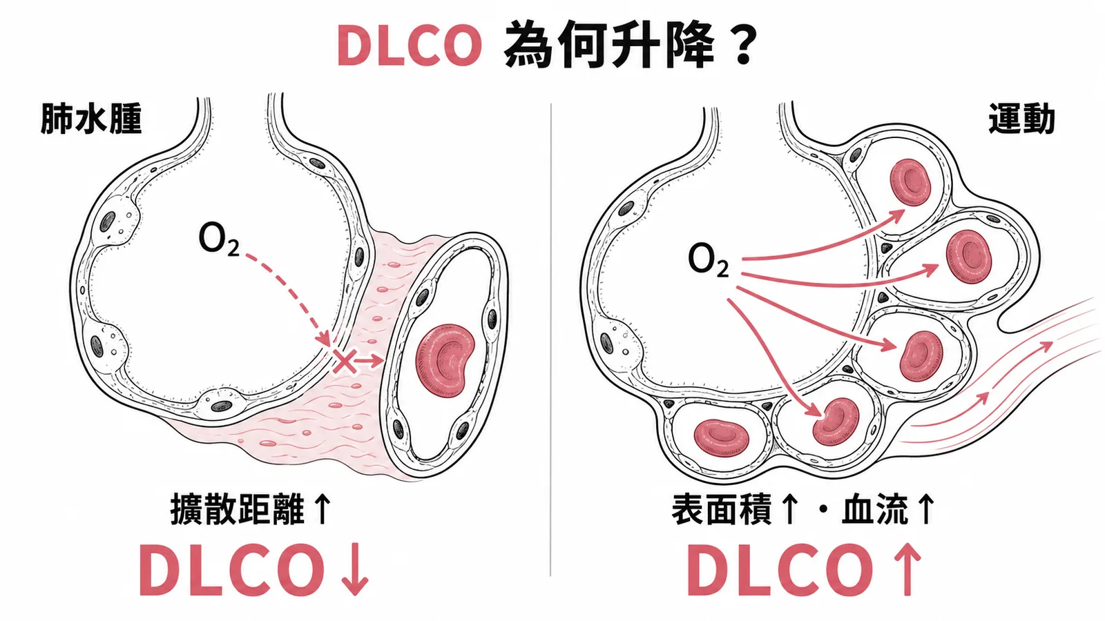 肺水腫與運動對 DLCO 影響的對照示意圖
