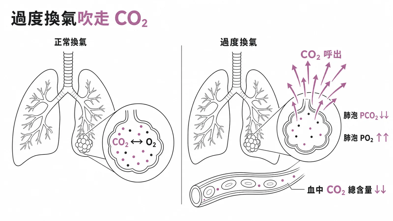 過度換氣對肺泡氣體分壓與血液 CO₂ 含量影響的對照示意圖