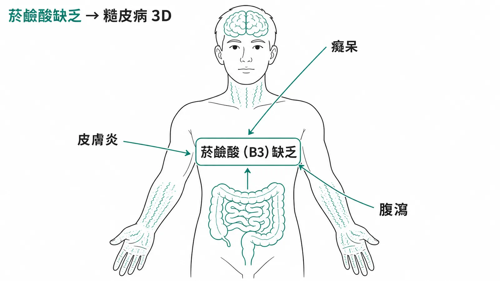 菸鹼酸缺乏導致糙皮病:皮膚炎、腹瀉、癡呆三大症狀