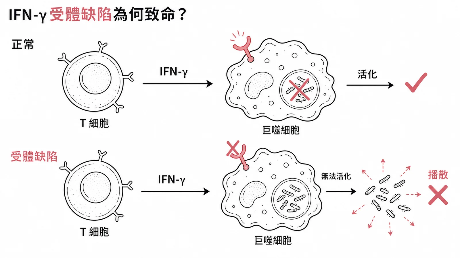 IFN-γ受體缺陷導致巨噬細胞無法活化,結核桿菌在體內播散