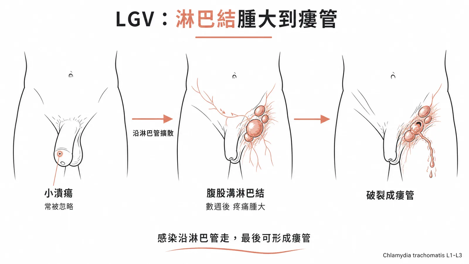 性病淋巴肉芽腫LGV病程:小潰瘍沿淋巴管擴散至腹股溝淋巴結腫大再破裂成瘻管