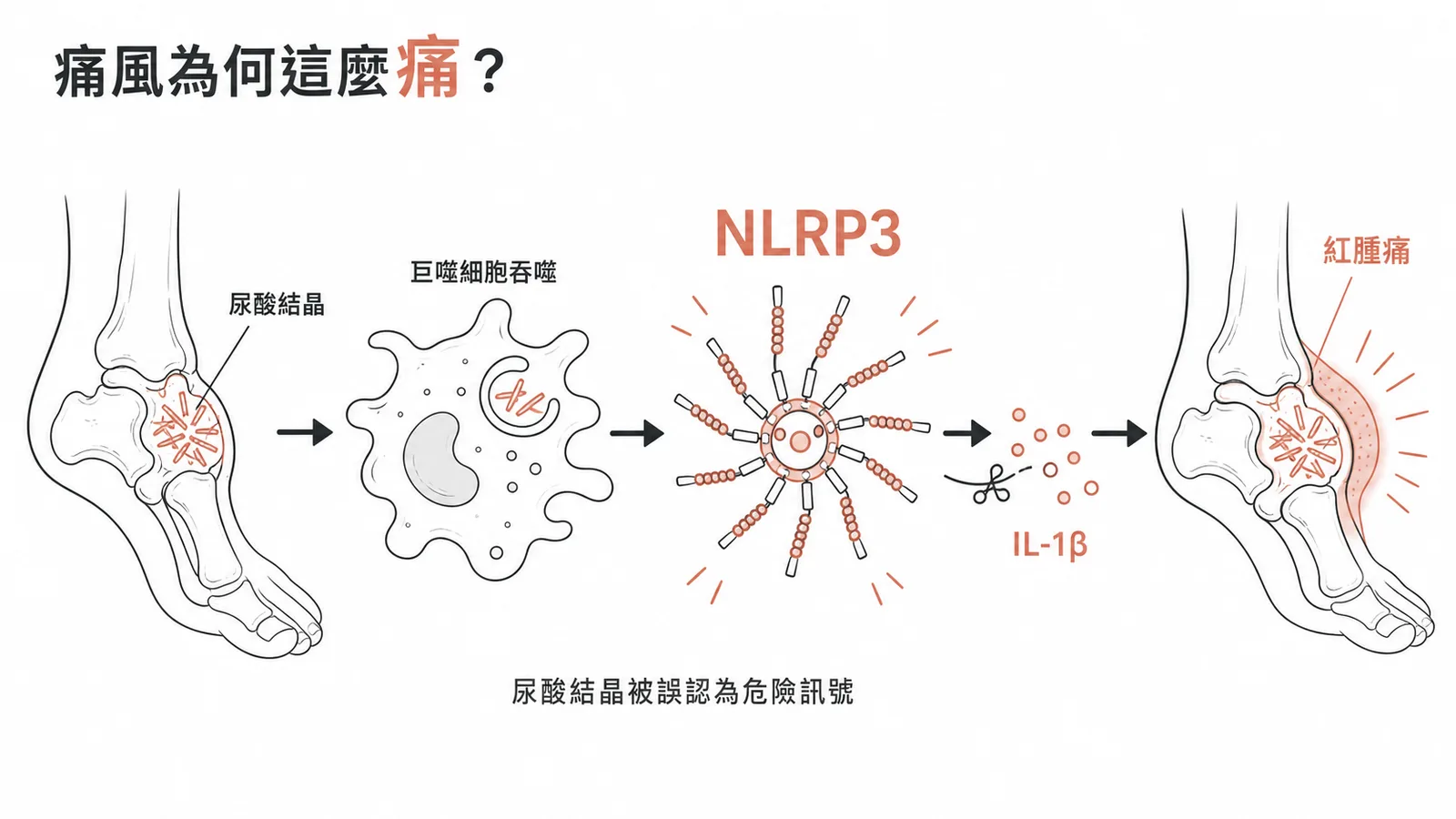 尿酸結晶活化 NLRP3 發炎小體釋放 IL-1β 引發痛風發炎
