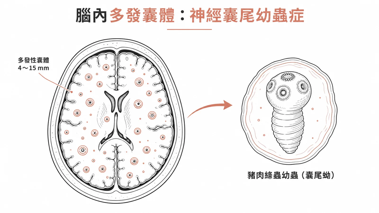 豬肉絛蟲囊尾蚴造成腦囊尾幼蟲症,腦內多發 4~15 mm 囊體
