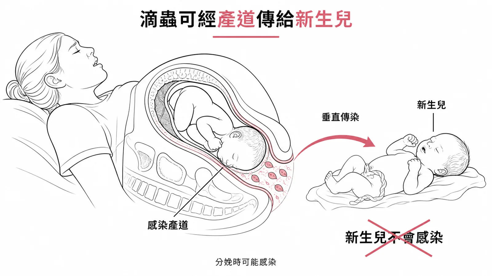 陰道滴蟲可經分娩時的感染產道垂直傳染新生兒,故新生兒不會感染屬錯誤敘述