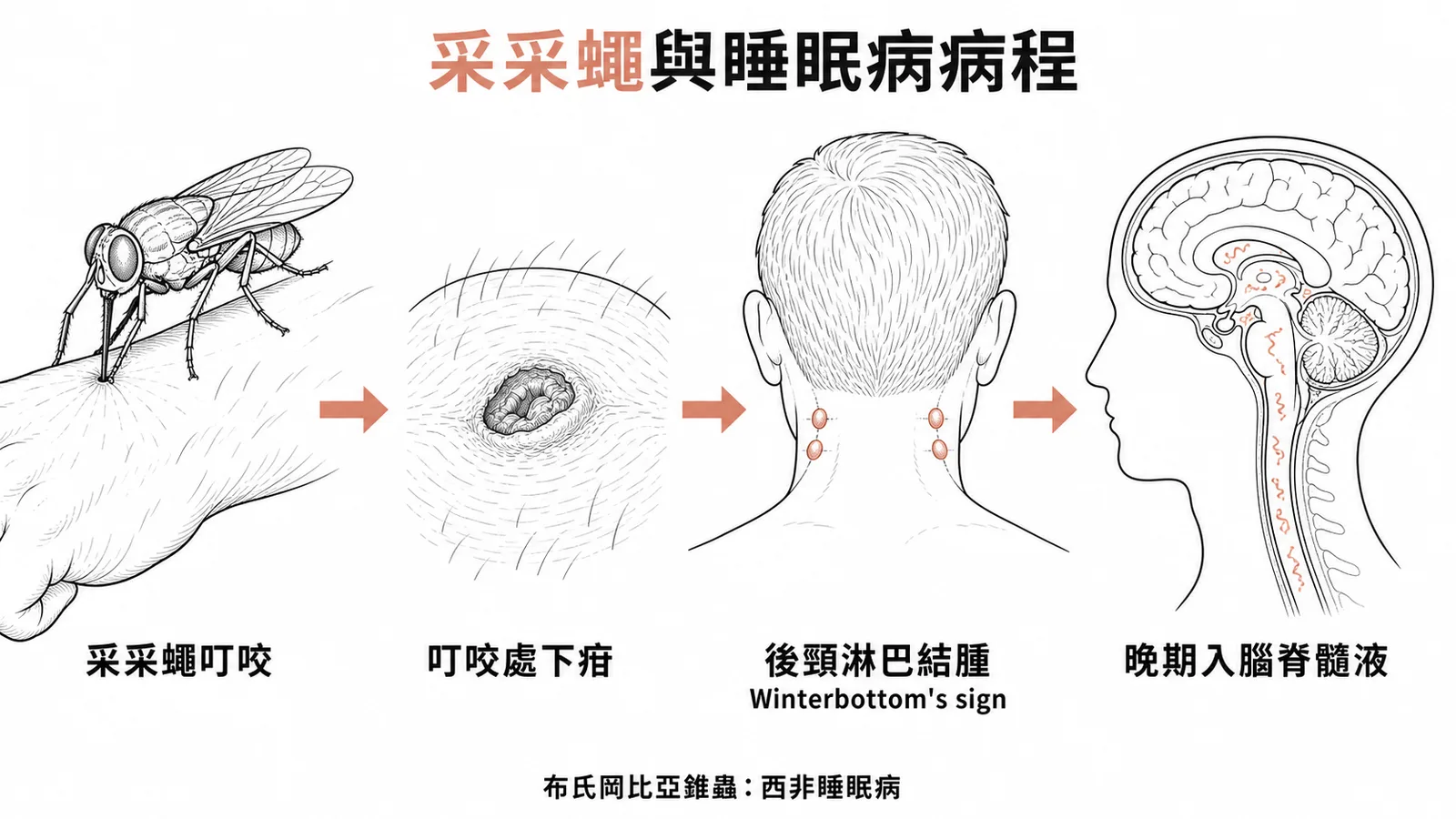 采采蠅傳布氏岡比亞錐蟲：下疳→後頸淋巴結腫（Winterbottom's sign）→晚期侵犯中樞