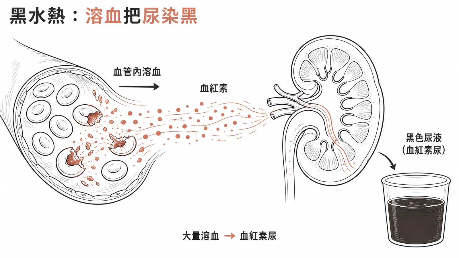 黑水熱:惡性瘧血管內大量溶血,血紅素經腎排出使尿液變黑