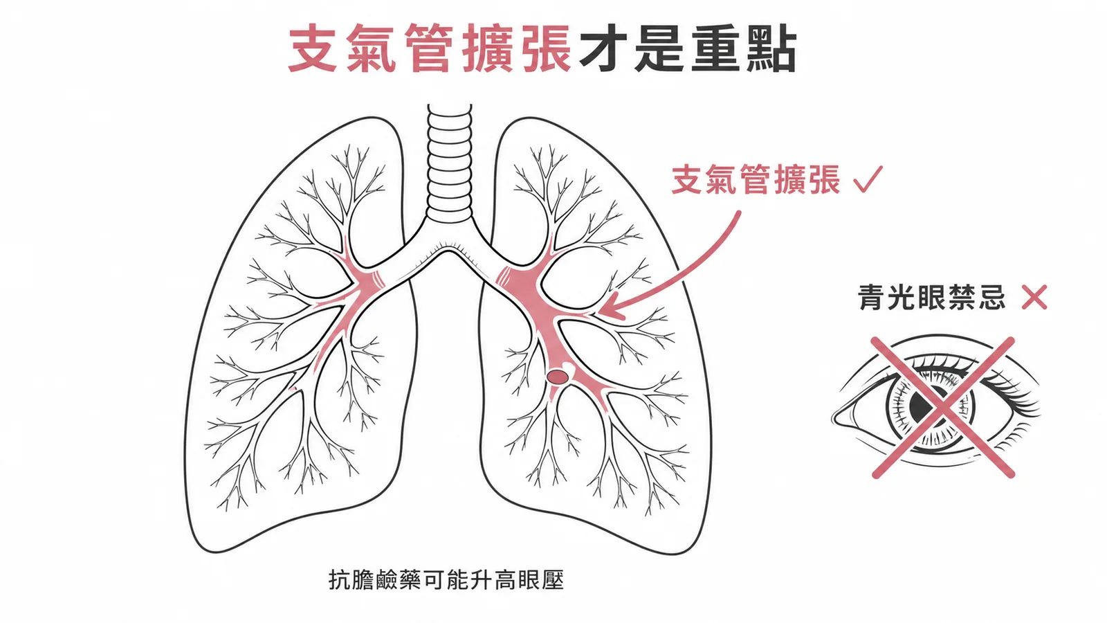 Ipratropium 是支氣管擴張劑而非青光眼用藥