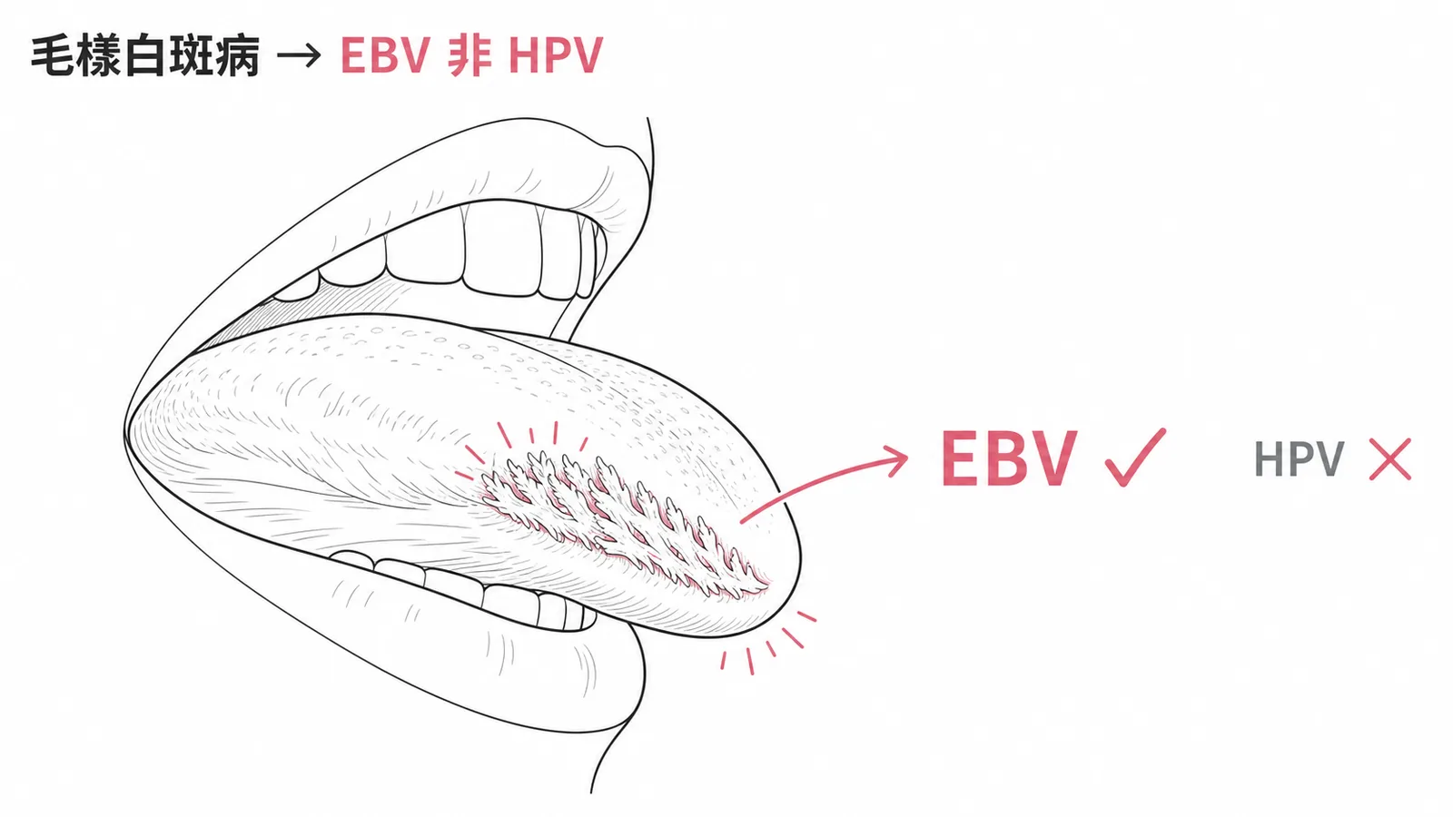 毛樣白斑病由 EBV 引起而非 HPV 示意圖