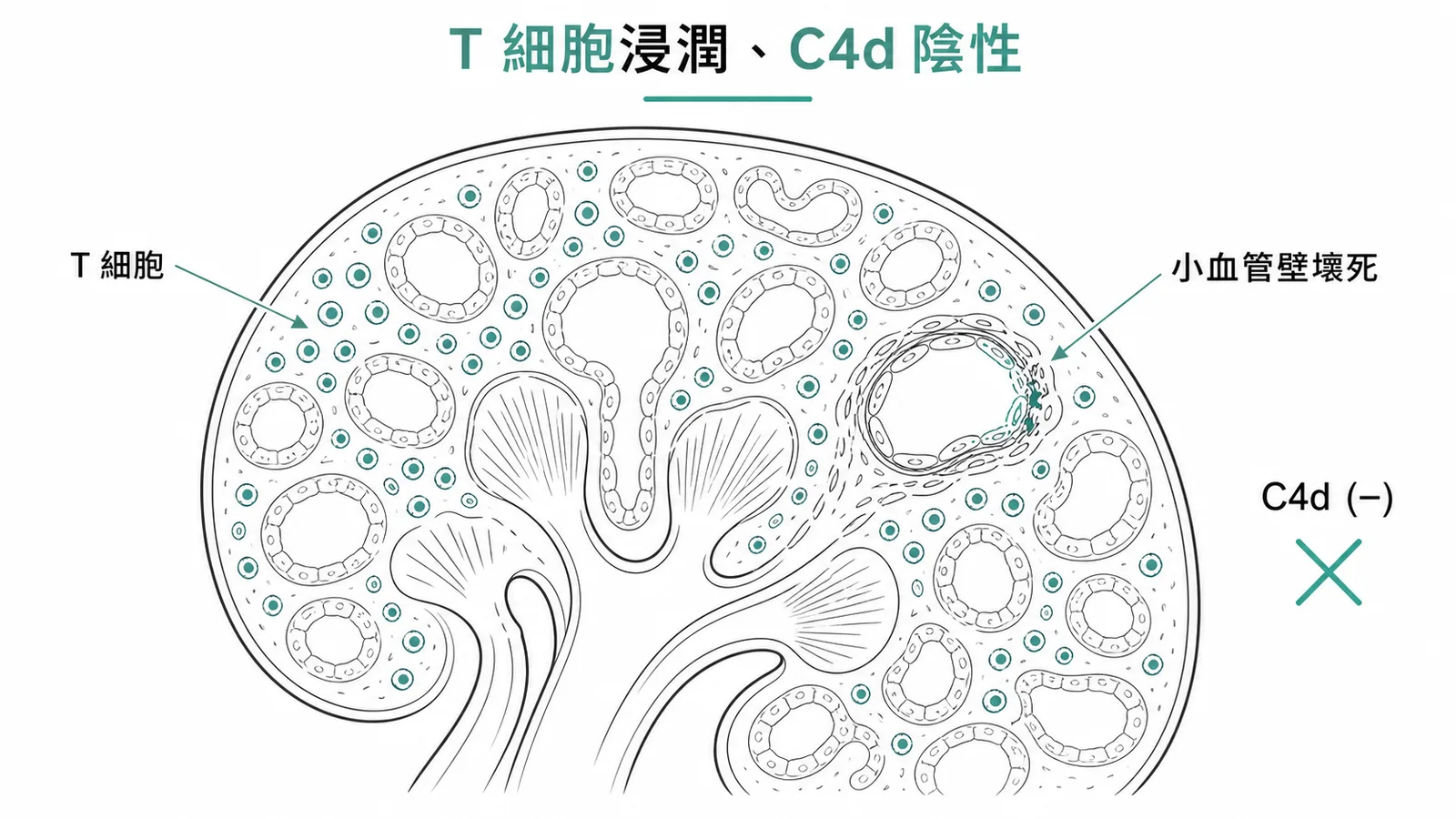 急性細胞排斥特徵為淋巴細胞浸潤且無 C4d 沉積示意圖