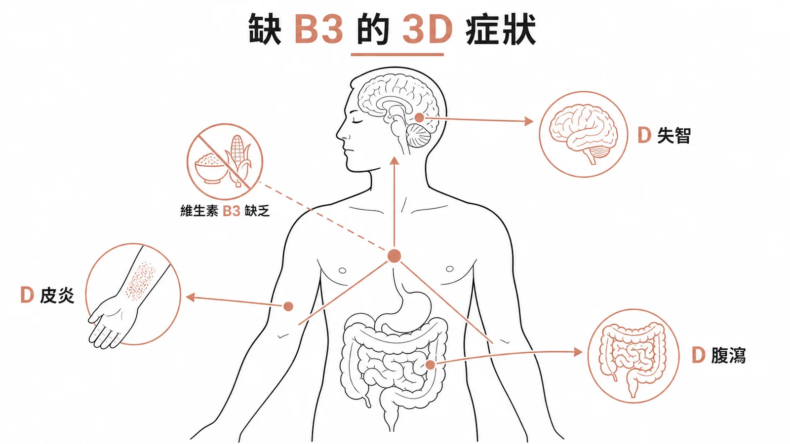 癩皮病 3D 症狀示意圖:皮炎、腹瀉、失智三大表現