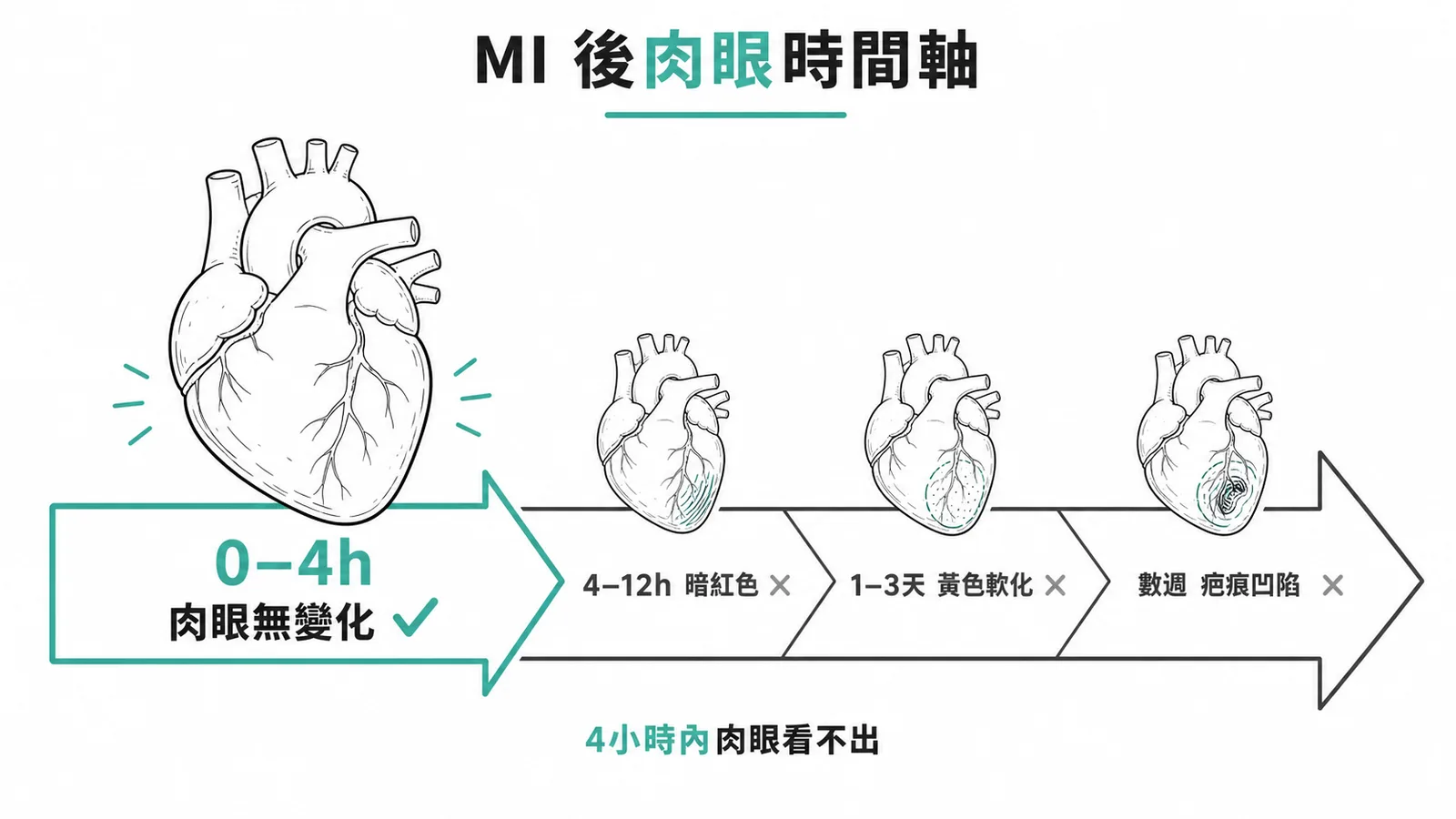 心肌梗塞後肉眼病理變化時間軸:3小時內尚無變化