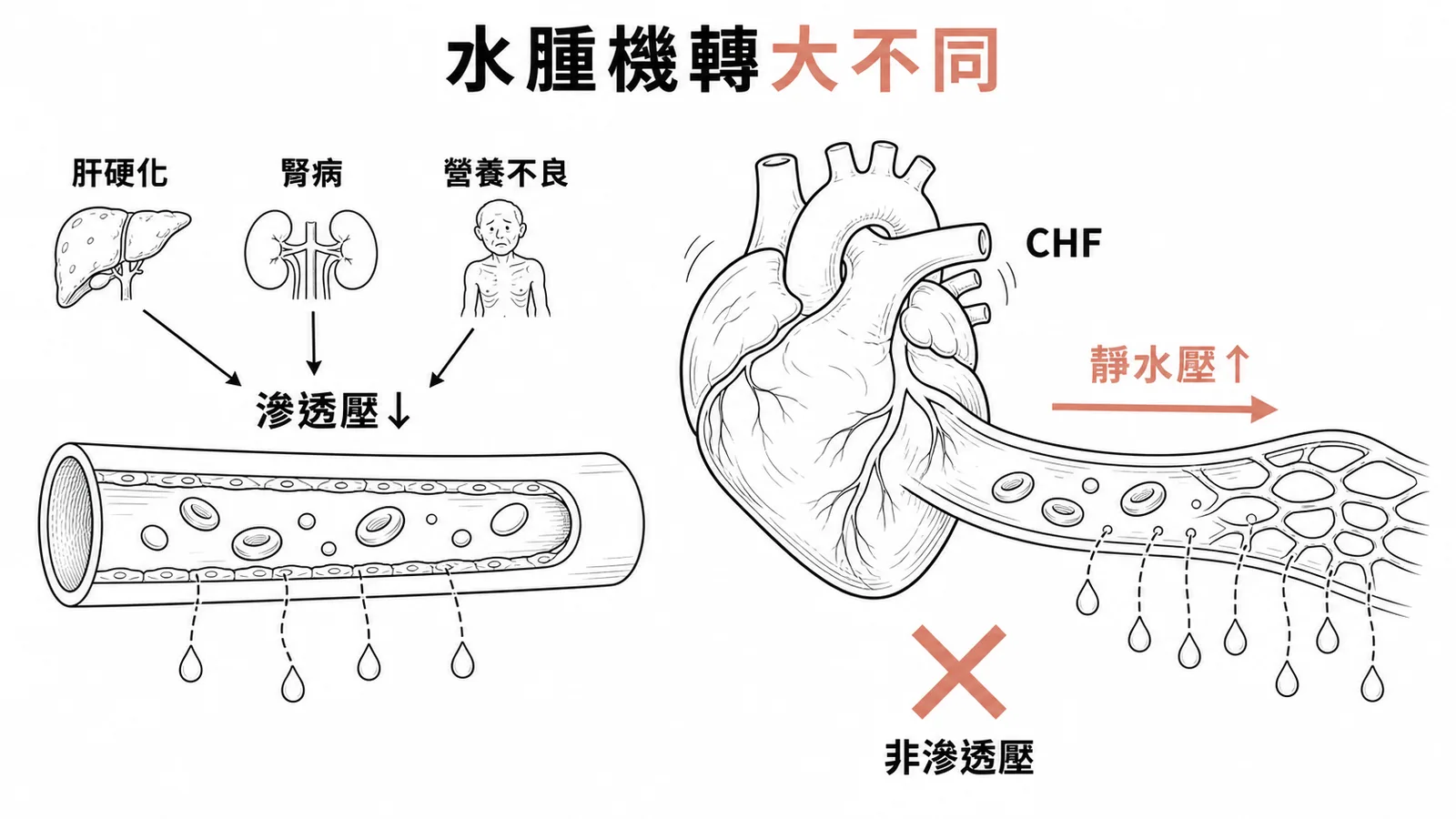 水腫機轉對照:滲透壓下降 vs 靜水壓上升(CHF)