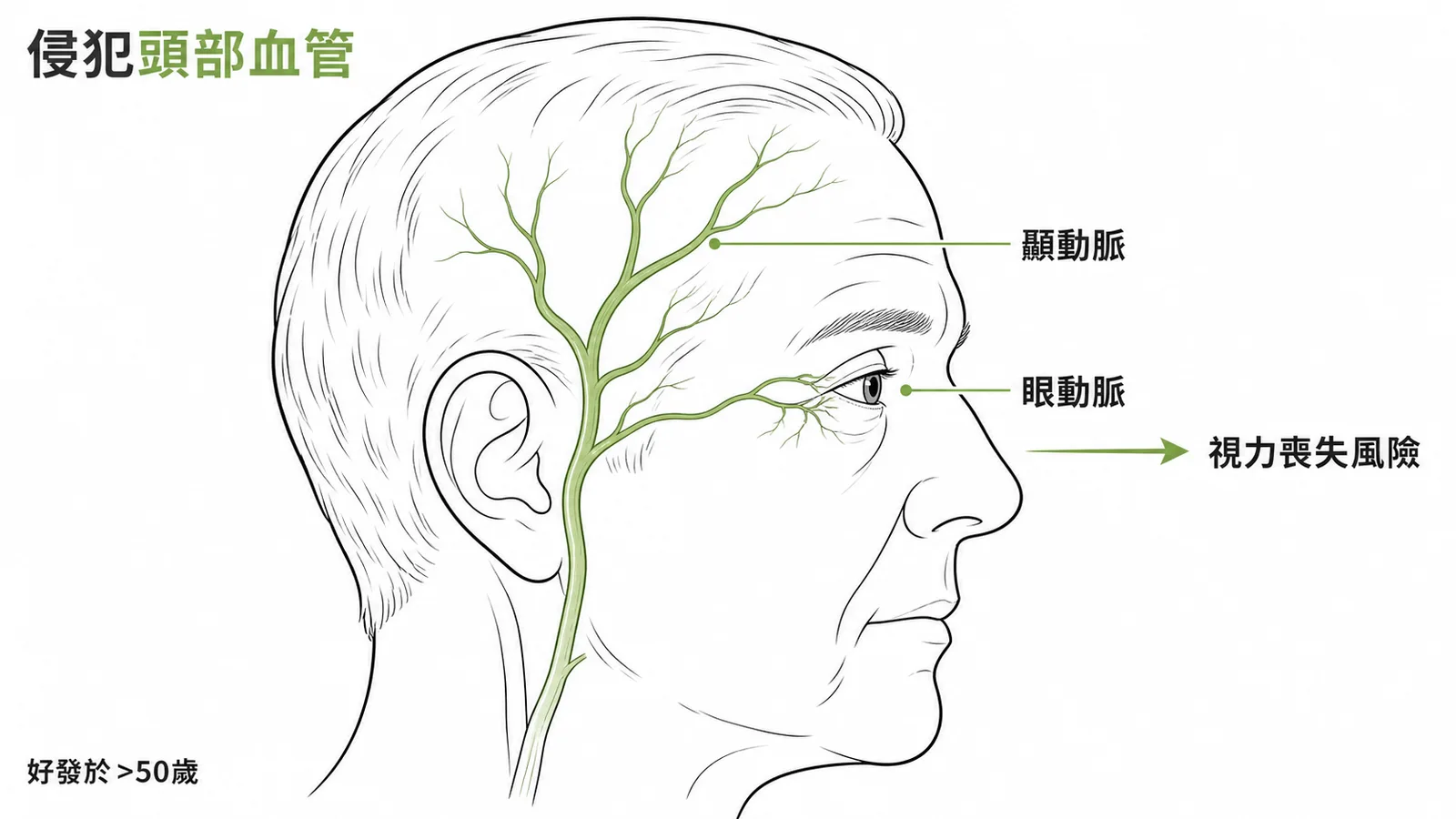巨細胞動脈炎侵犯頭部顳動脈與眼動脈示意圖