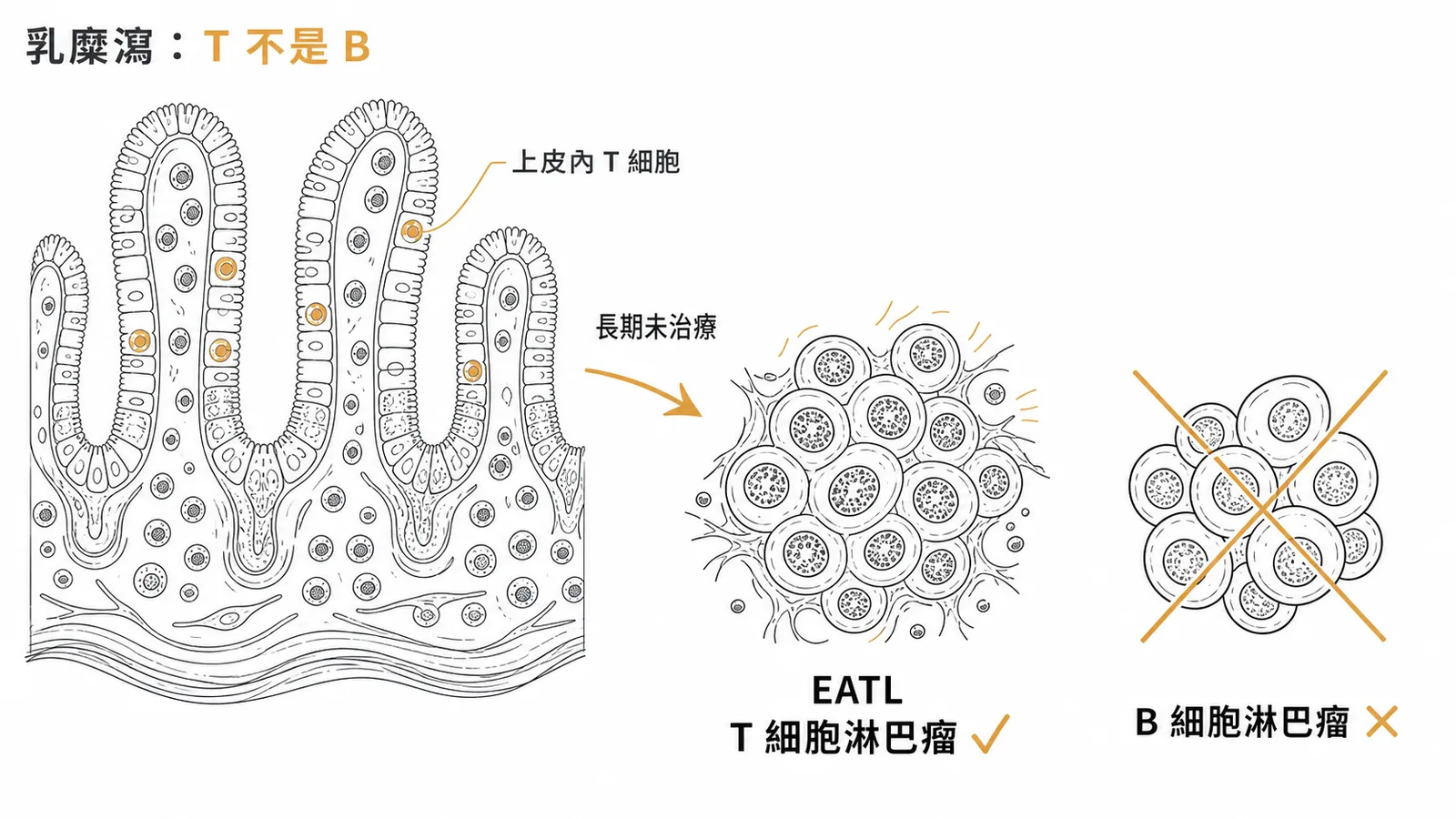 乳糜瀉長期未治療可致 EATL(T 細胞淋巴瘤)示意圖
