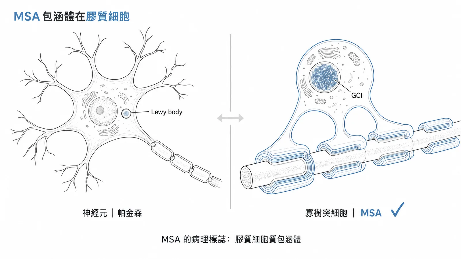 MSA 的 α-synuclein 包涵體位於寡樹突細胞(GCIs)示意圖