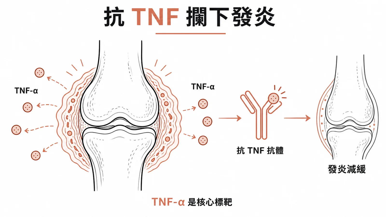 TNF 在類風濕關節炎的角色與抗 TNF 標靶治療示意圖