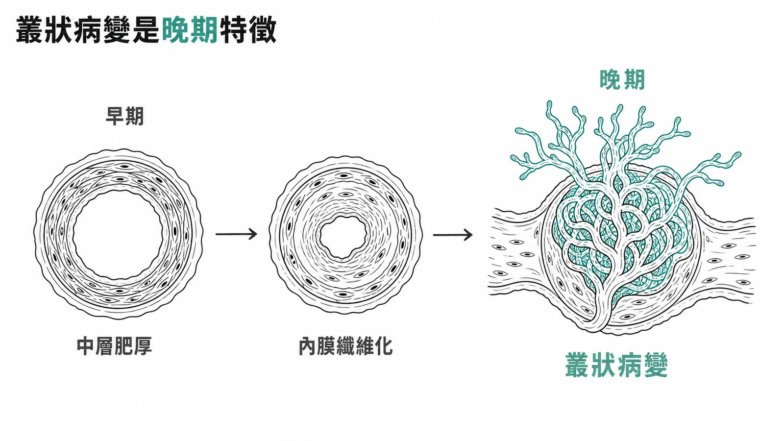 肺高壓病理變化由早期到晚期的箭頭流程,叢狀病變標示為晚期特徵