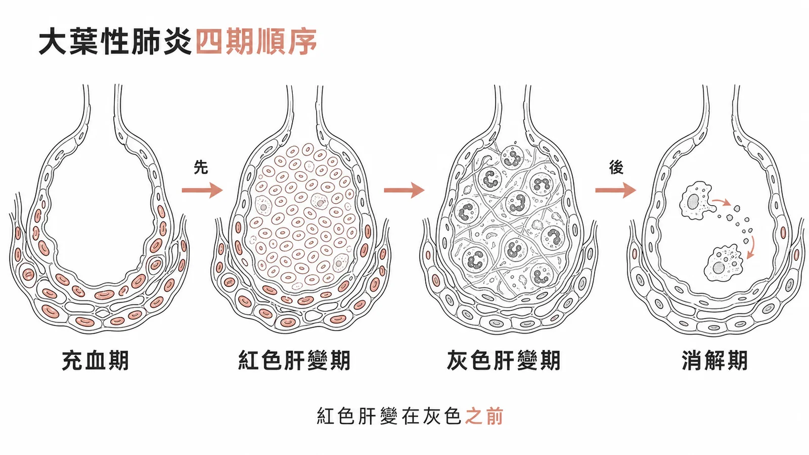 大葉性肺炎四期病理變化箭頭流程：充血期→紅色肝變期→灰色肝變期→消解期