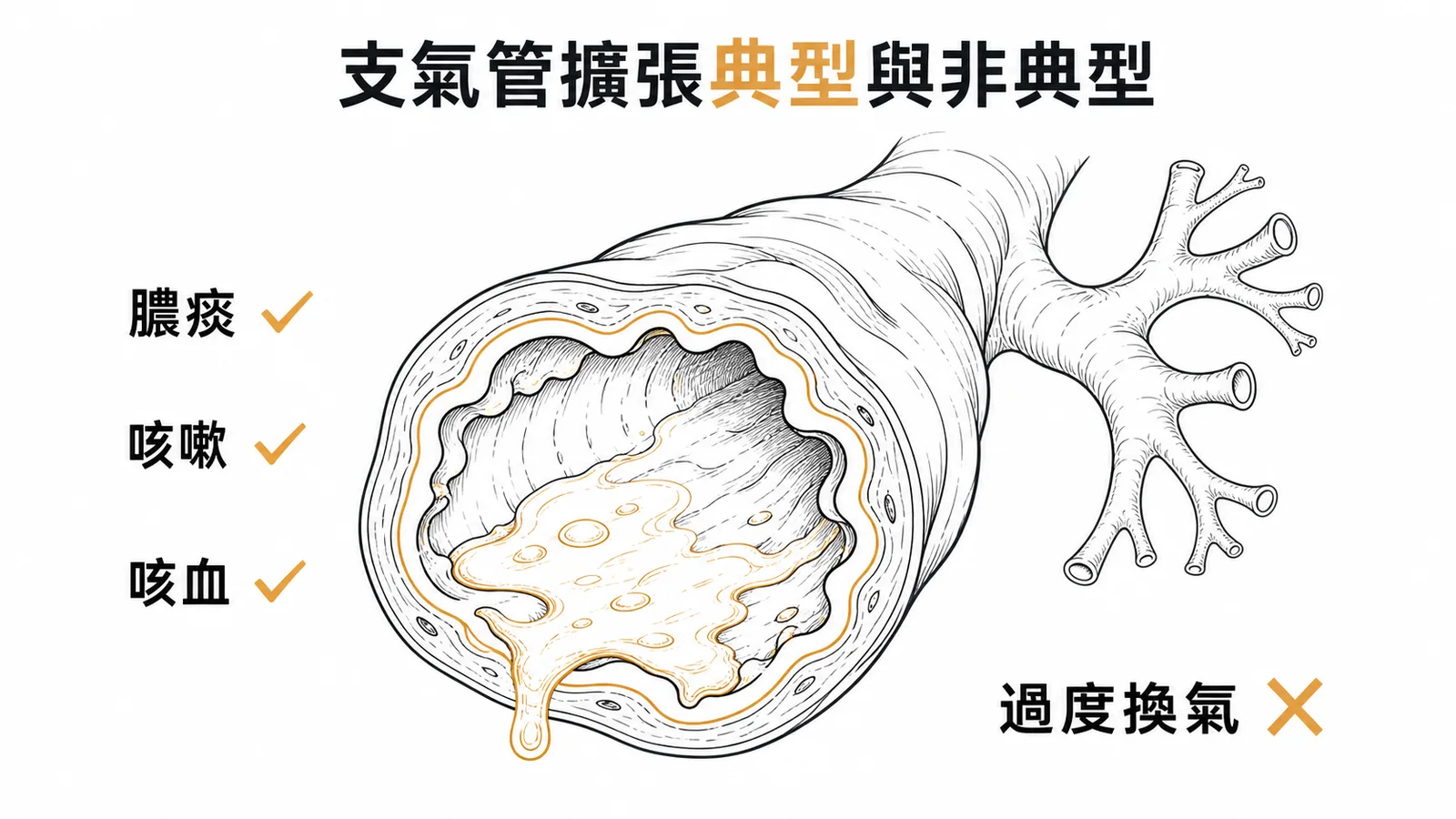 支氣管擴張症典型症狀與非典型症狀對照:膿痰、咳嗽、咳血打勾,過度換氣打叉