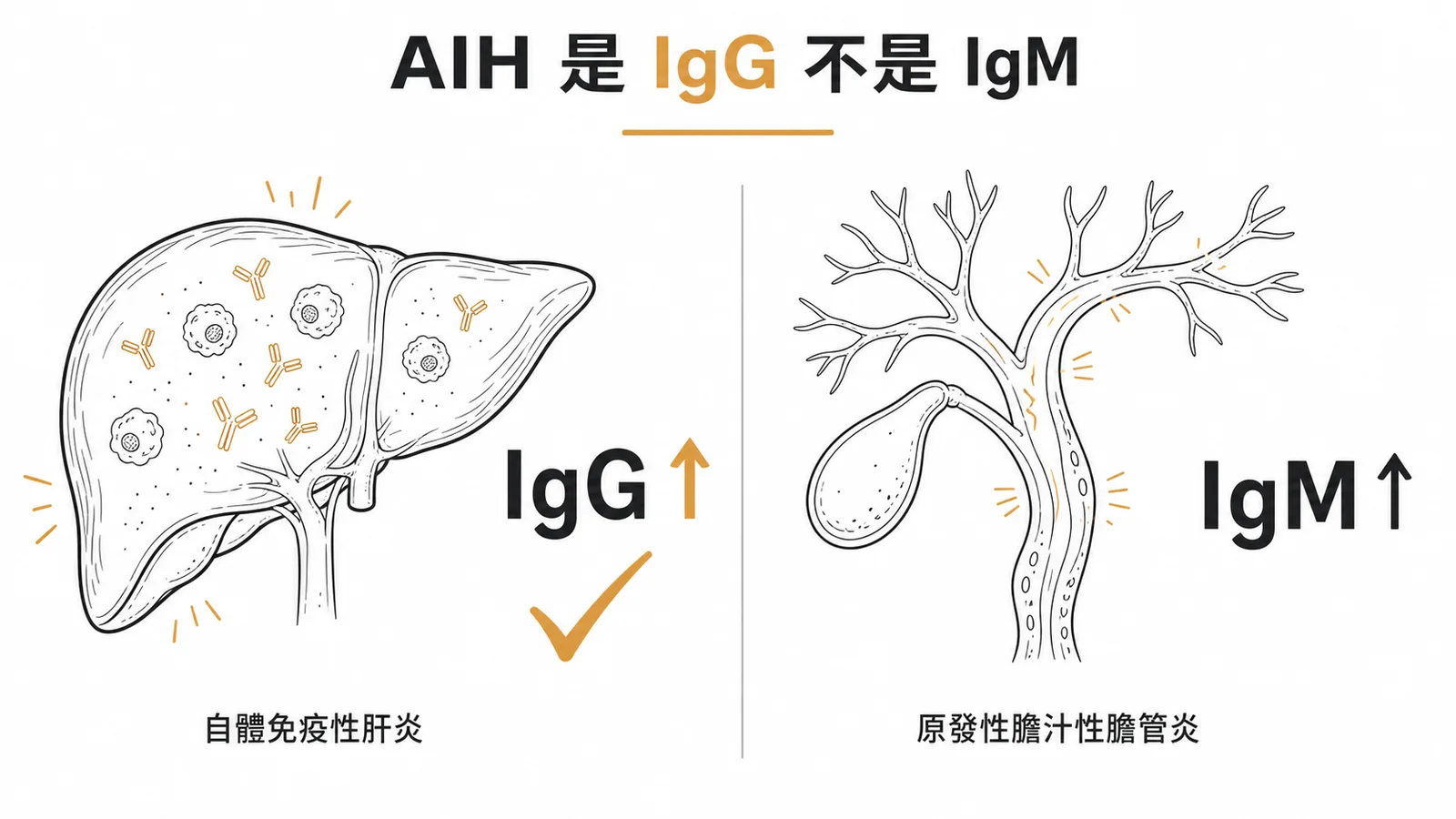 自體免疫性肝炎與原發性膽汁性膽管炎的免疫球蛋白對照:AIH 對應 IgG 升高,PBC 對應 IgM 升高