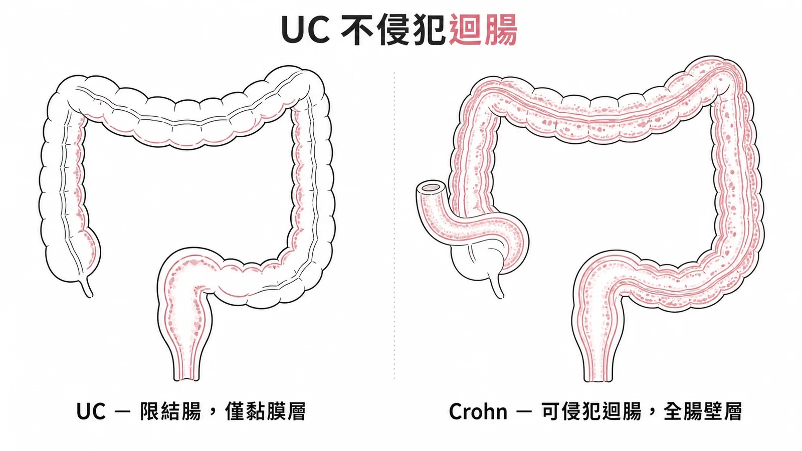 潰瘍性結腸炎與克隆氏症侵犯範圍對照:UC 限於結腸黏膜層,Crohn 可侵犯迴腸全層
