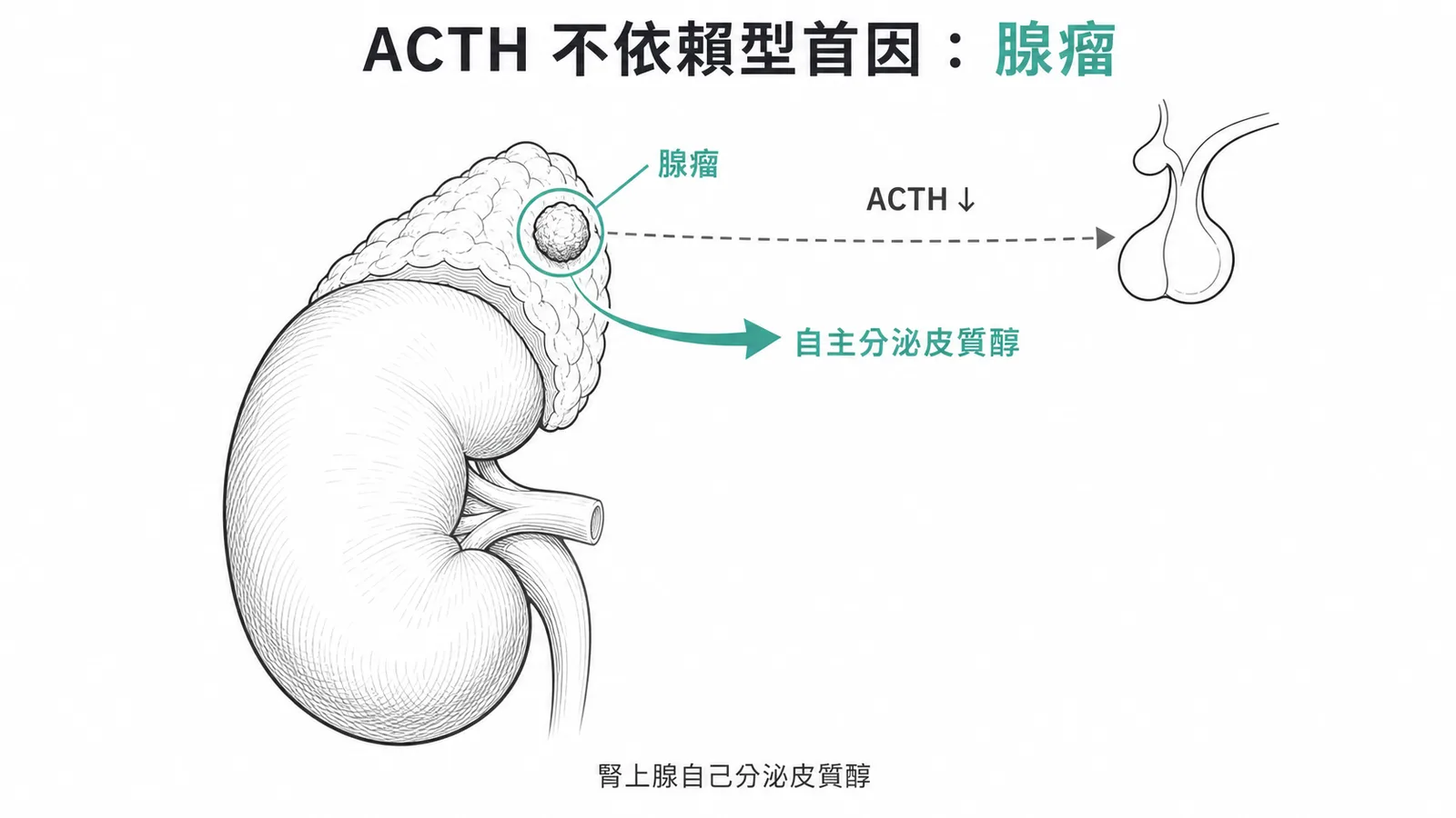 庫欣氏症候群分類示意:ACTH依賴型源自腦下垂體,ACTH不依賴型最常見為腎上腺皮質腺瘤