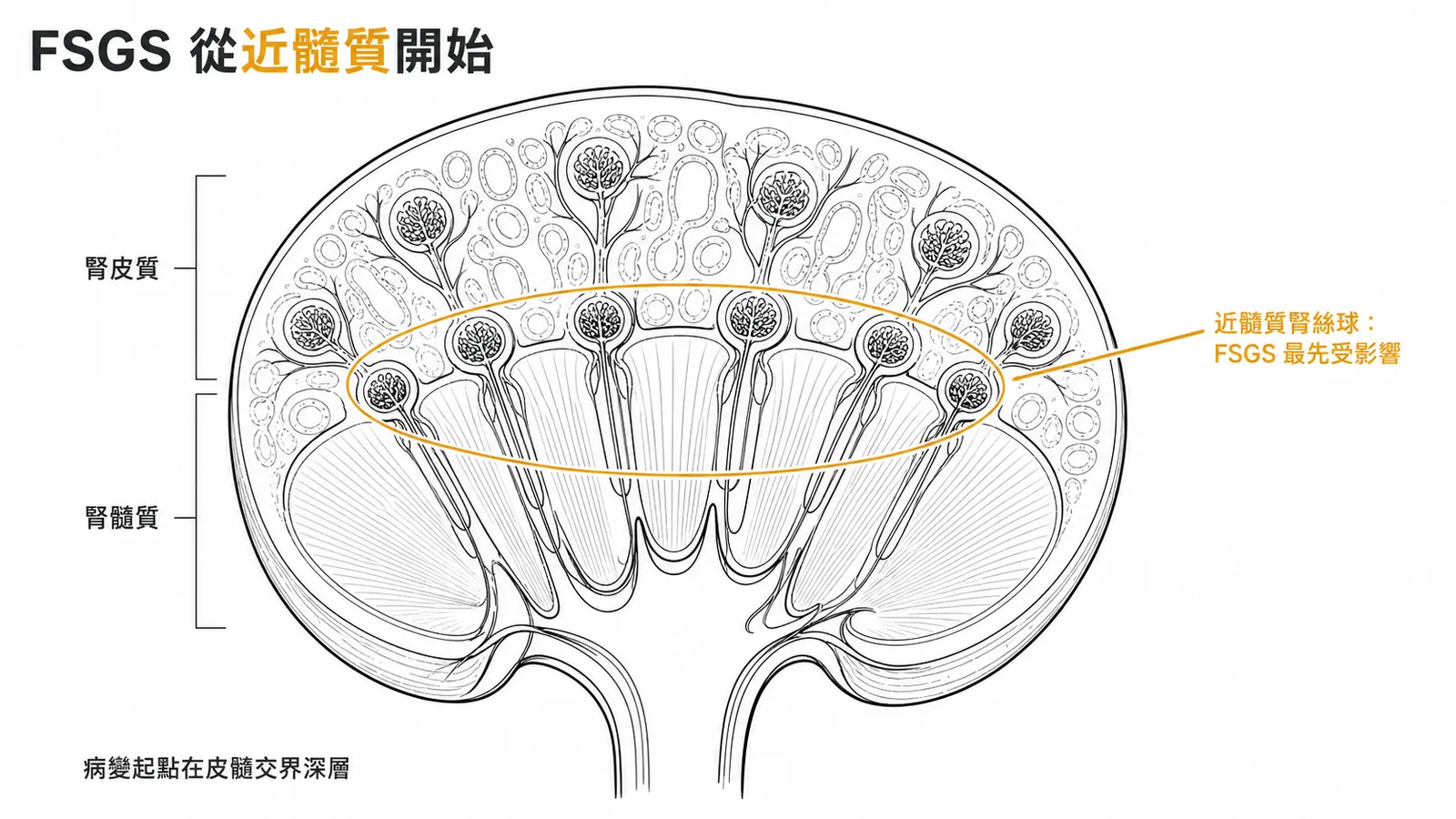 FSGS 病變起始位置示意:腎臟剖面標出近髓質腎絲球為最先受影響的位置
