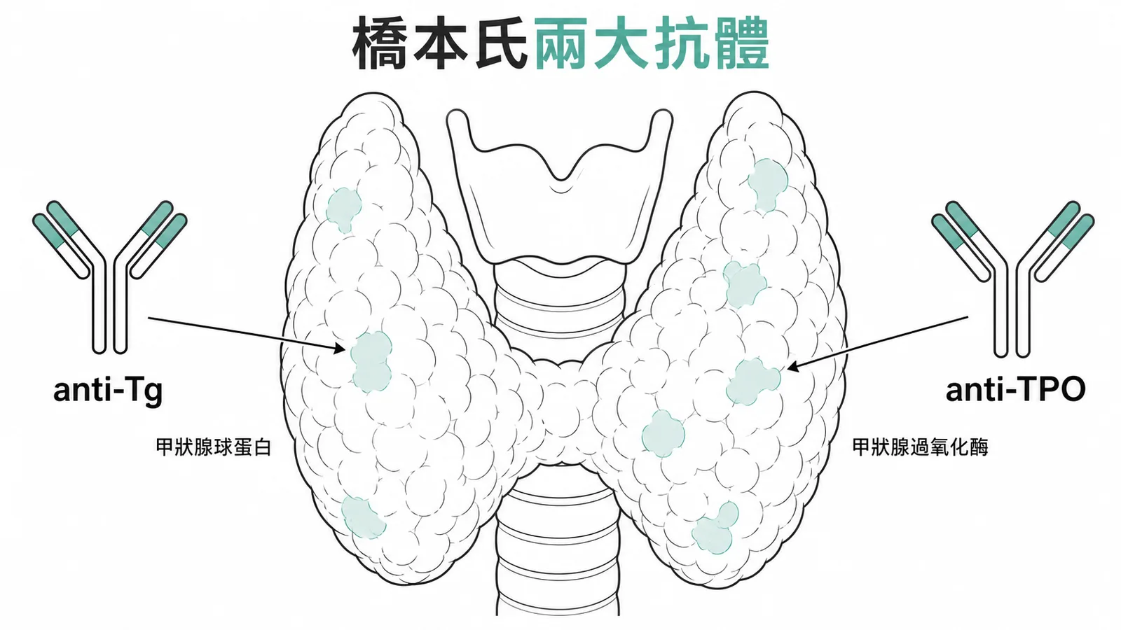 橋本氏甲狀腺炎特徵抗體示意:甲狀腺上標示 anti-Tg 和 anti-TPO 兩種自體抗體攻擊目標