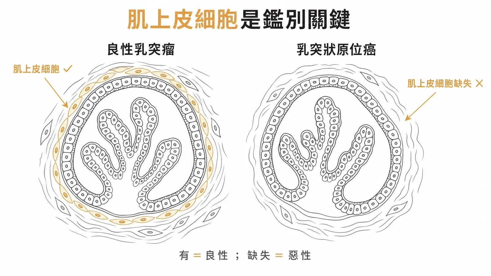 乳房良性乳突瘤與乳突狀原位癌對照:良性保留肌上皮細胞層,惡性失去肌上皮細胞層