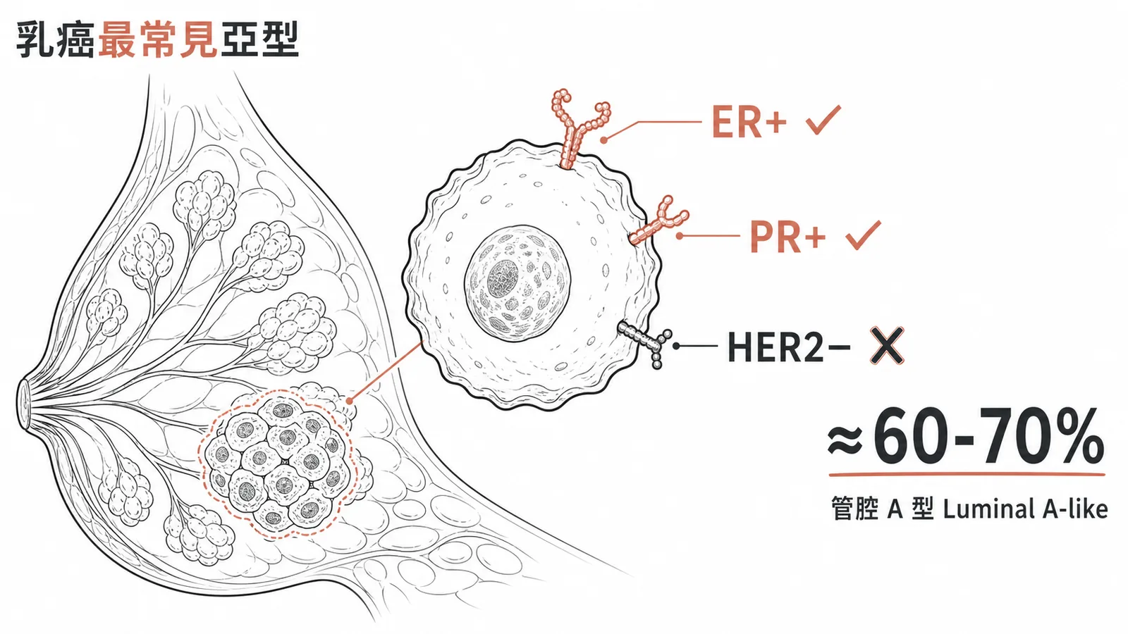 侵犯性乳癌分子亞型佔比示意：Luminal A（ER+/PR+/HER2−）佔最大比例約60-70%