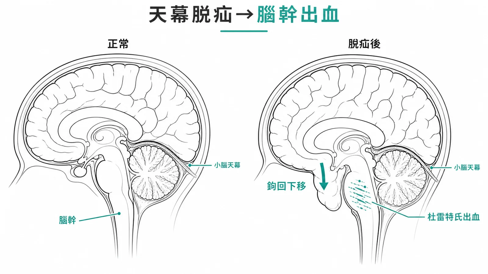 經小腦天幕脫出導致腦幹穿通動脈拉扯的杜雷特氏出血機轉示意圖