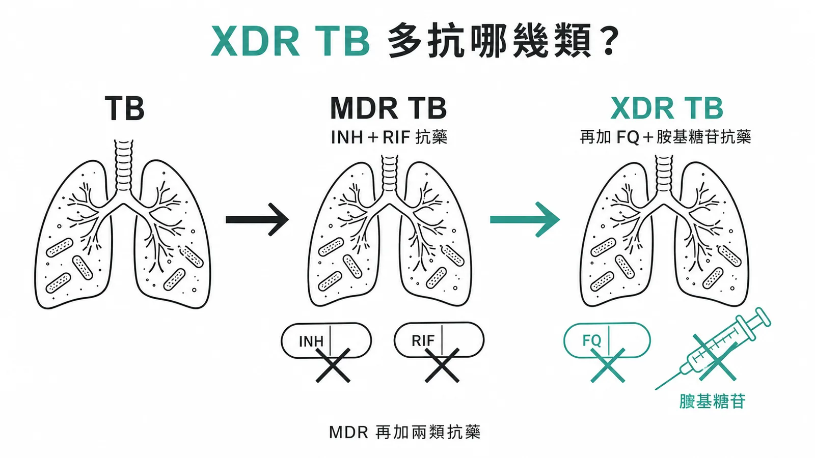 抗藥結核分級：MDR 到 XDR 的層遞