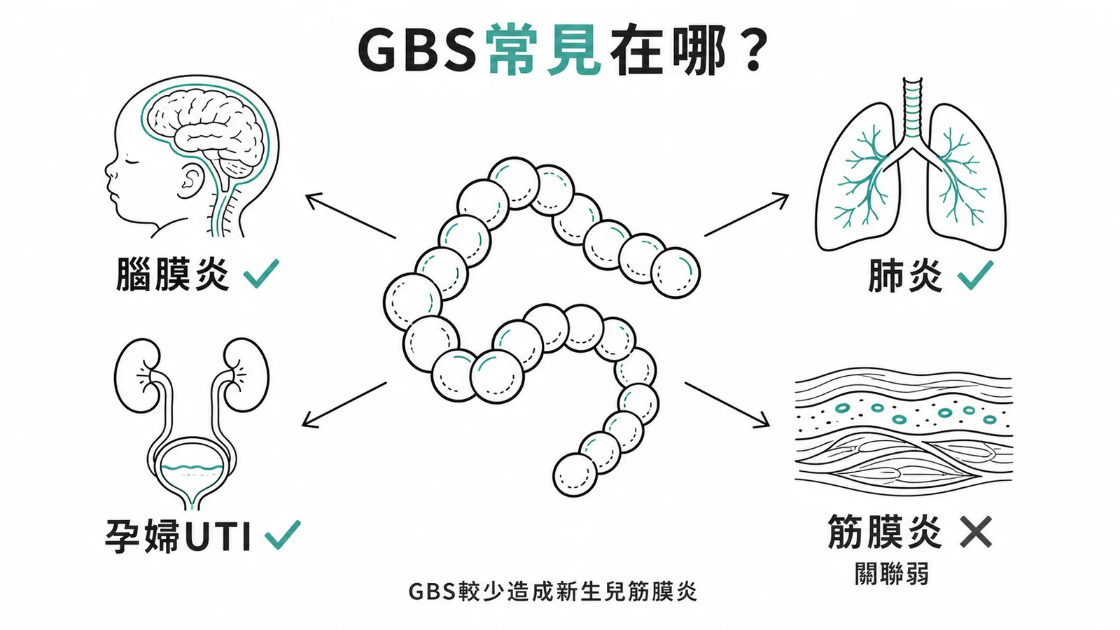 無乳鏈球菌常見感染與筋膜炎的罕見關聯