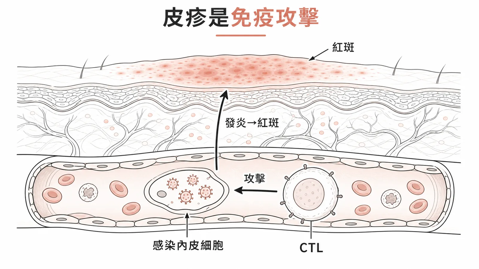 麻疹皮疹機轉：T 細胞攻擊被感染血管內皮引發紅斑