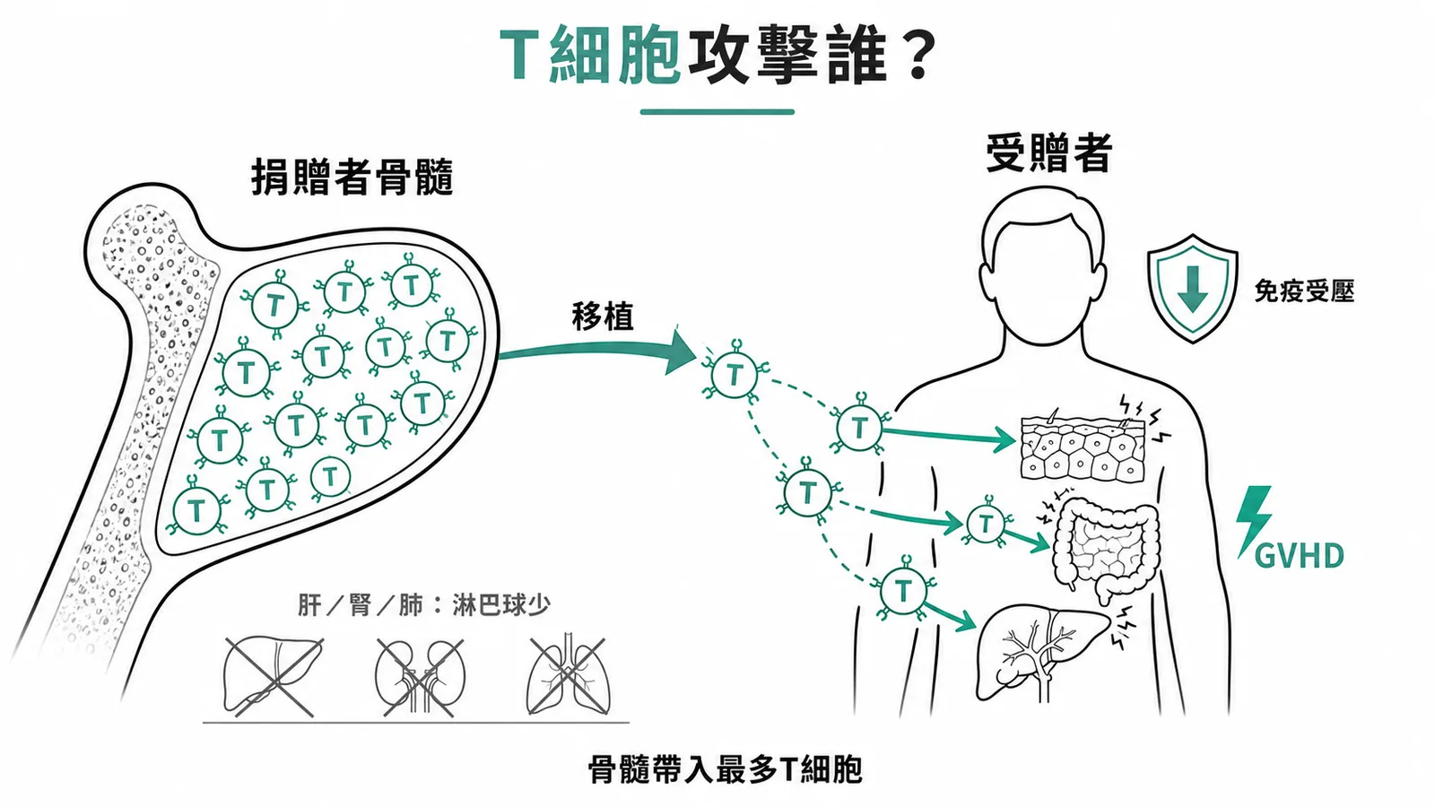 骨髓移植因含大量捐贈者 T 細胞最易發生 GVHD