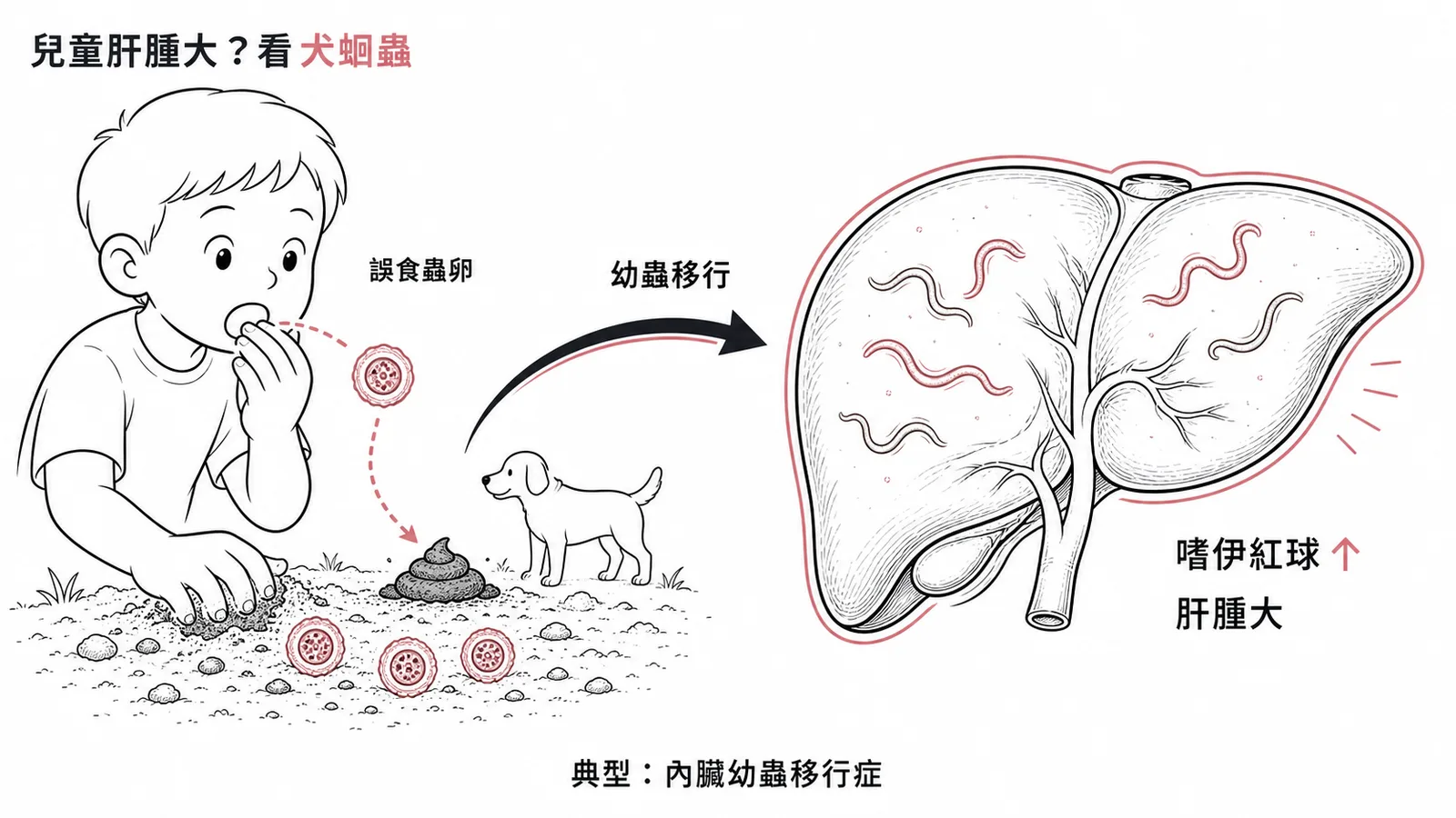 犬蛔蟲幼蟲移行至肝臟引起嗜伊紅性白血球增加與肝腫大的示意圖