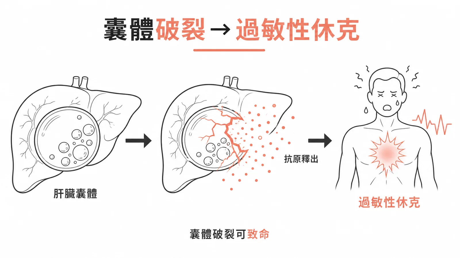 包生囊蟲病囊體破裂引發過敏性休克的示意圖