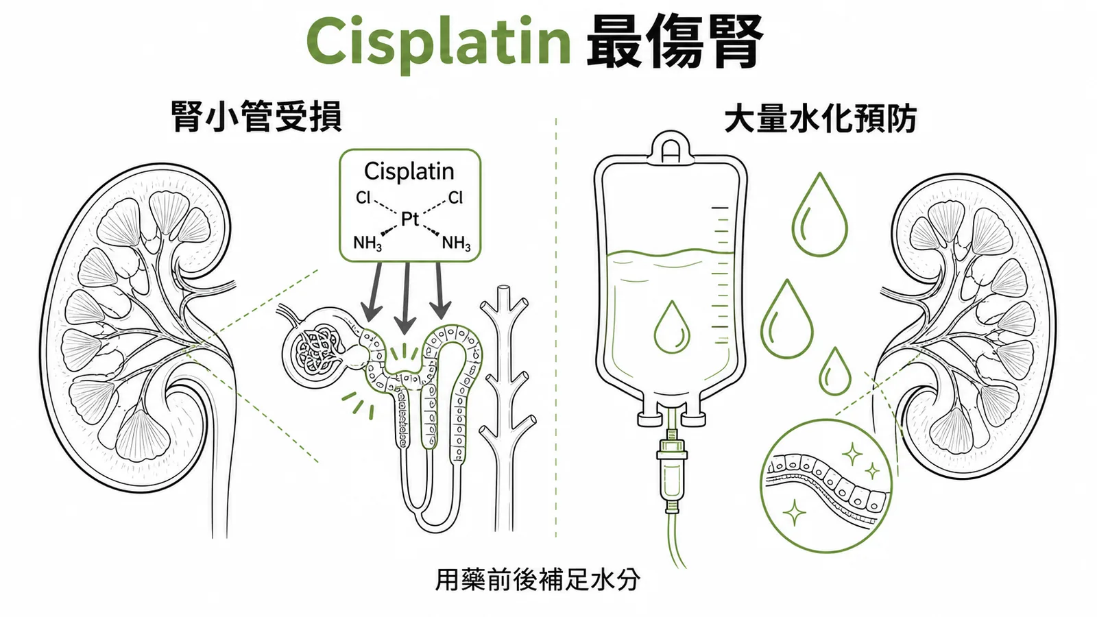 Cisplatin 腎毒性最強需大量水化預防示意圖