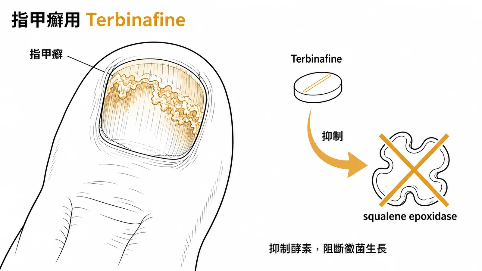 Terbinafine 抑制角鯊烯環氧化酶治療指甲癬示意圖