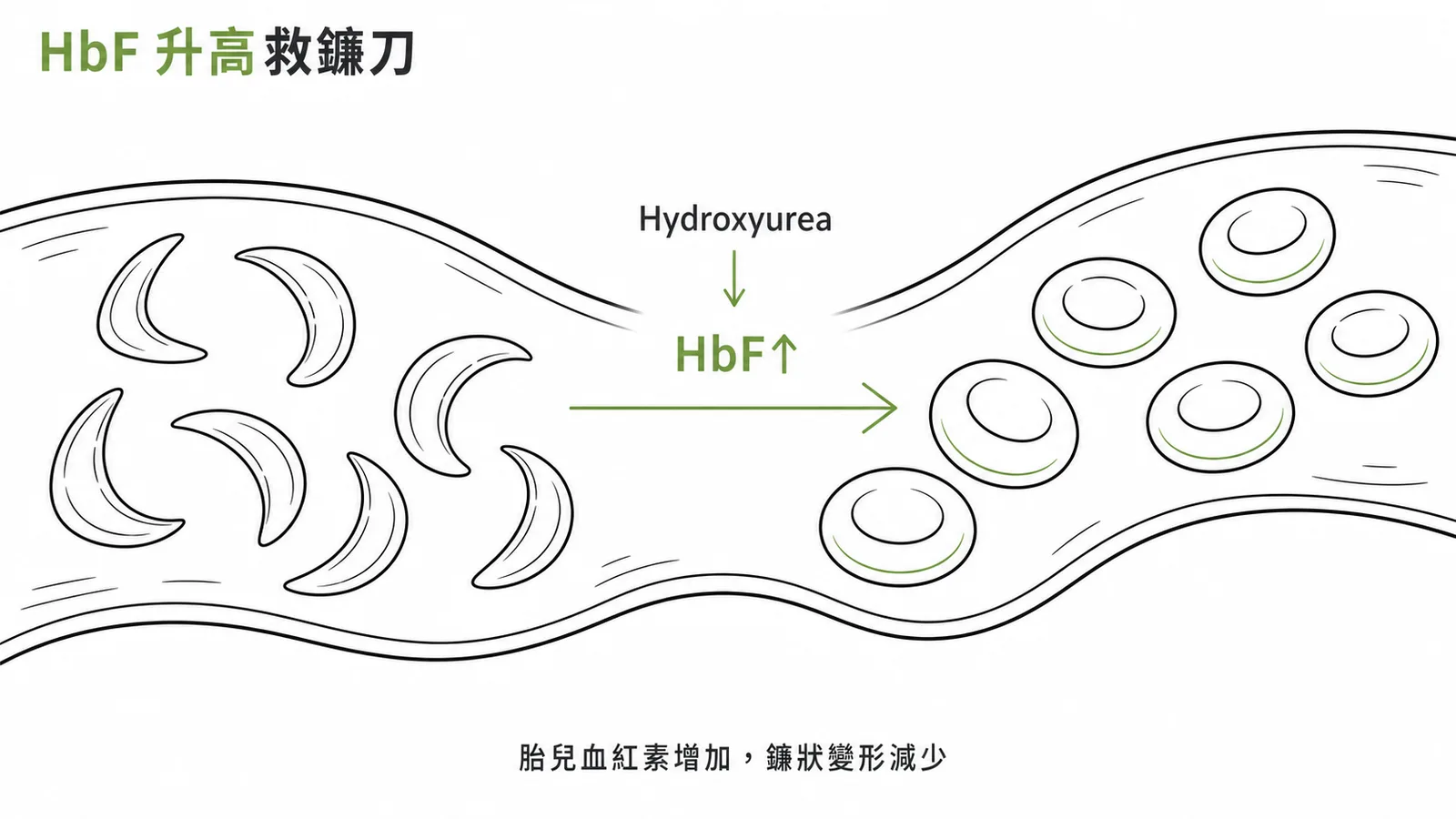 Hydroxyurea增加HbF救鐮刀型紅血球示意圖
